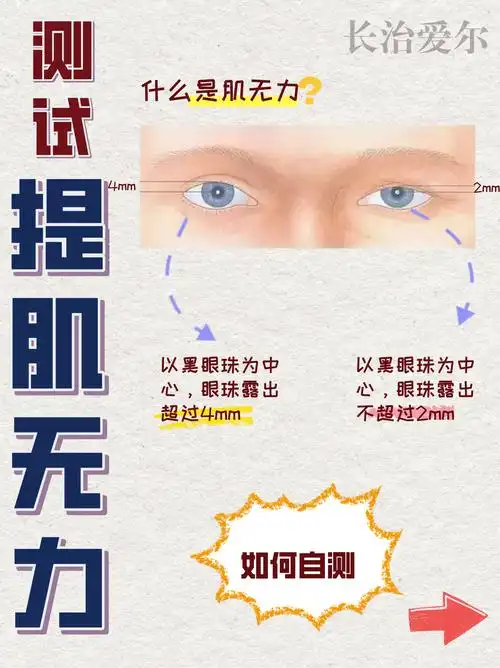 眼睛提肌无力眼部提肌眼睛肌无力眼睛肌无力的图片眼肌无力照片真实