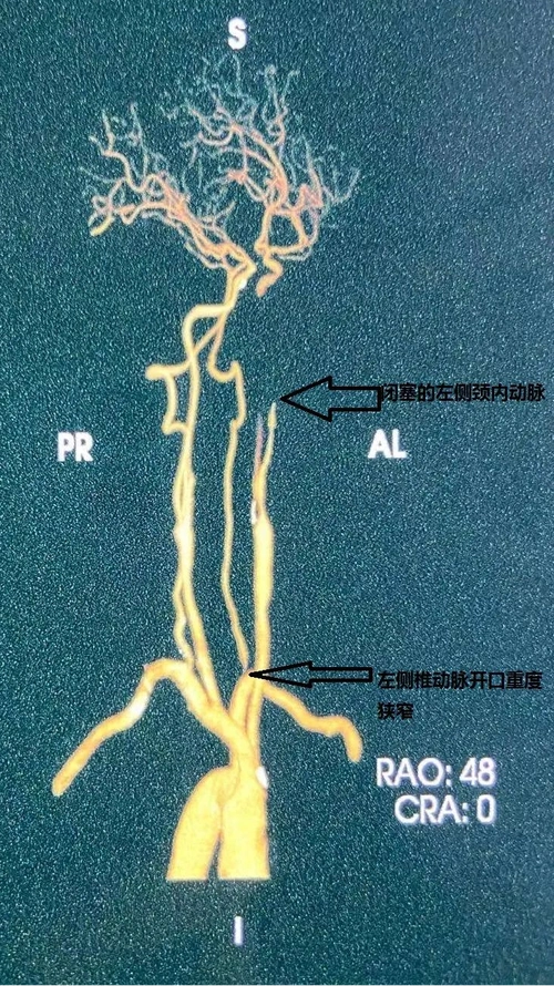 急诊椎动脉狭窄maurora03支架成形一例