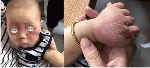 跳蚤—引发红疹,疼痛难痒,定期给宠物杀虫,以免传给孩子蝎子蜈蚣