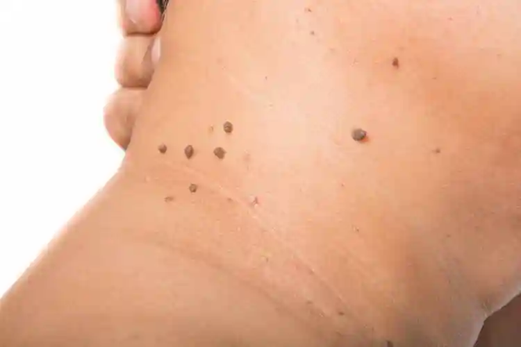 被人俗称的瘊子和色素痣有区别吗医生指出区别性