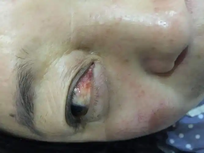我母亲眼珠上长了像息肉一样的东西,怀疑是翼状胬肉,请问是吗,严重吗?