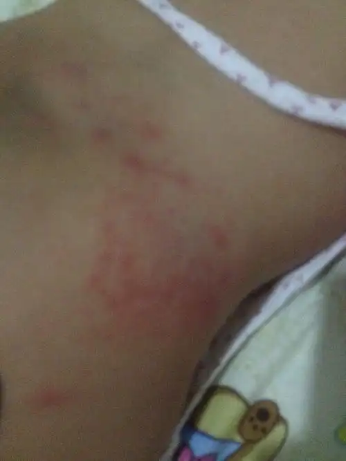 宝宝这两天换了一种纸尿裤 屁股上起的红点是怎么回事啊?