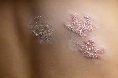 生殖器疱疹症状.传染性皮肤病例证生殖器疱疹症状.