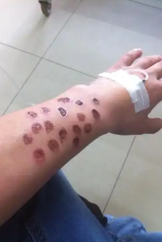 女朋友把我甩了,我烫了好多烟疤