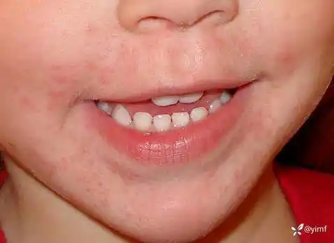 这种面部湿疹样皮疹不能用激素涂抹