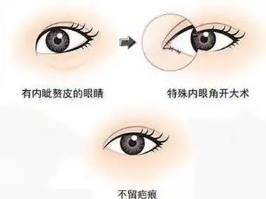 开眼角前后果对比