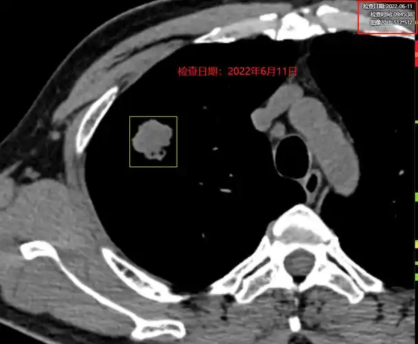 巫医生阅片以后,发现这个结节是一个典型的周围型肺癌.