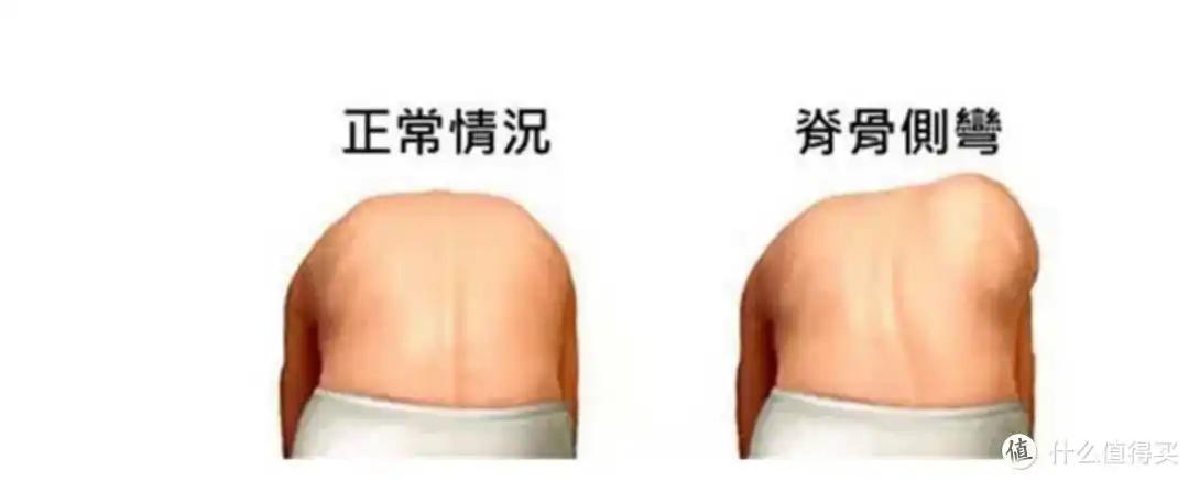 含胸驼背的小孩那么多孩子越大背越驼深度科普帮你矫正驼背
