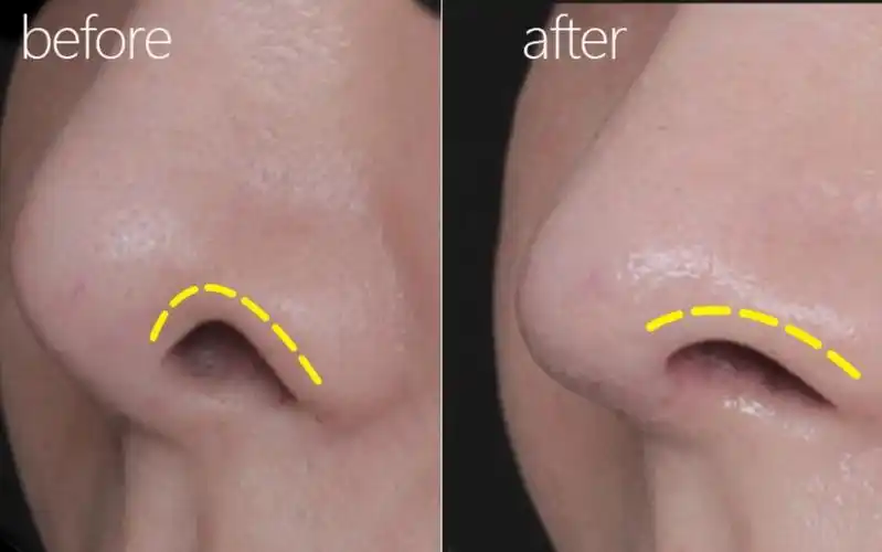 国内鼻翼缘退缩矫正哪个医生做的好刘彦军李劲良巫文云牛永敢