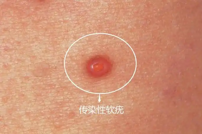皮肤肉粒疣图片