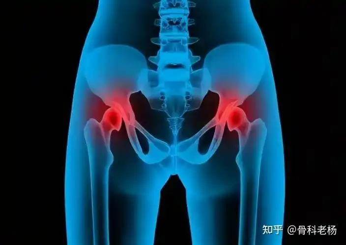 股骨头坏死晚期需密切关注这些症状