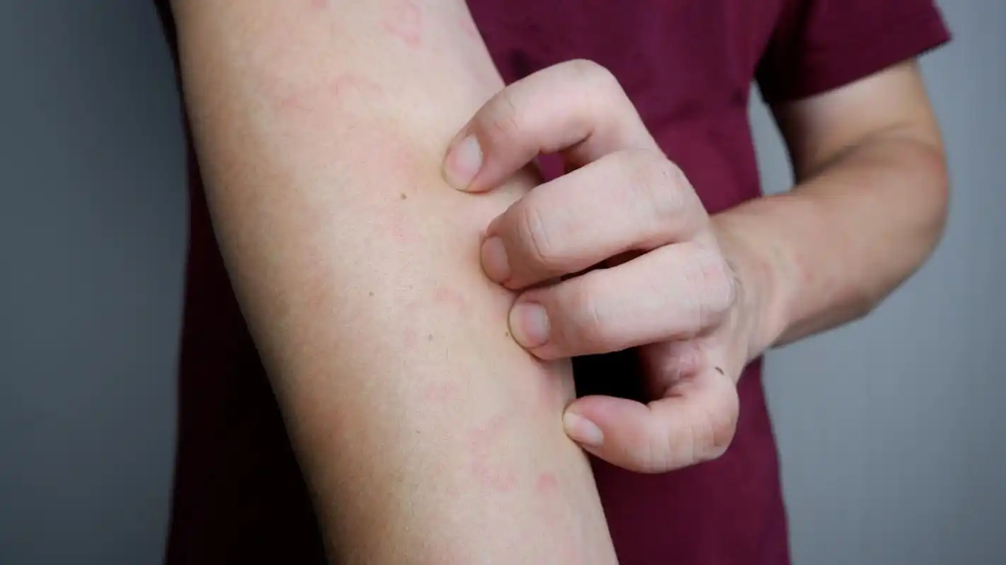 麻疹是一种高度传染的病毒性疾病,尤其在儿童中传播迅速.