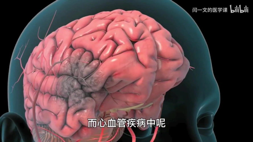 脑梗塞严重威胁生命如何及时发现