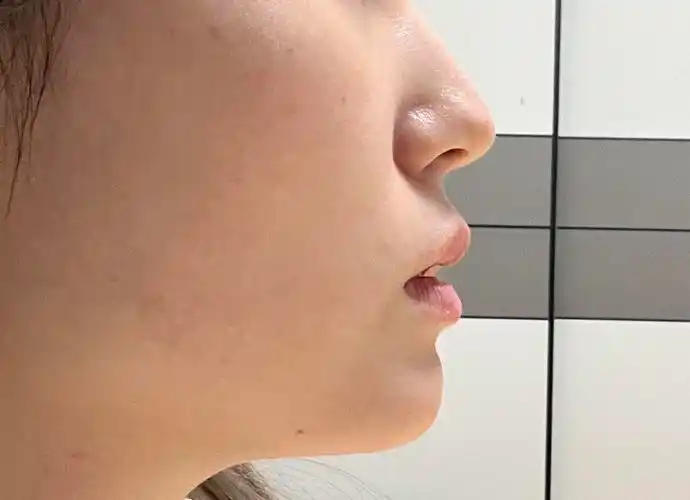 这样的鼻基底凹陷需要调整一下吗