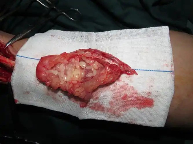 左踝部包块 - 骨科与显微外科专业讨论版 - 爱爱医医学论坛