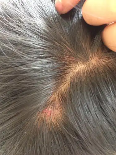 上的旋的地方起小疙瘩结痂,抠掉了又长,总不好,抠下来的像死皮,灰褐色