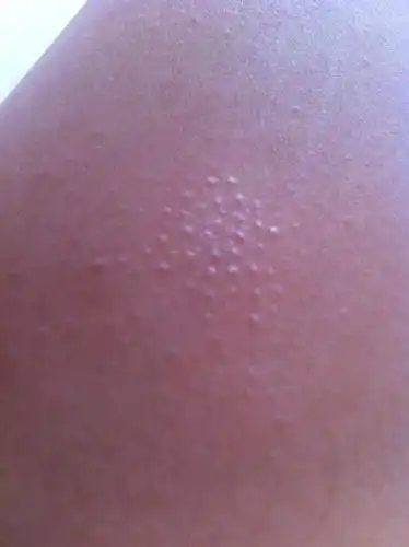 身上起了一片一片的小疙瘩,不疼不痒,什么原因