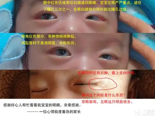 请各位帮忙看看我宝宝的眼睛,是角结膜囊肿吗?
