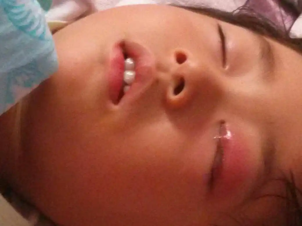 3岁的女孩,眼皮肿,前几天长个厥眼,好了,这几天眼皮肿,亮肿那样,急