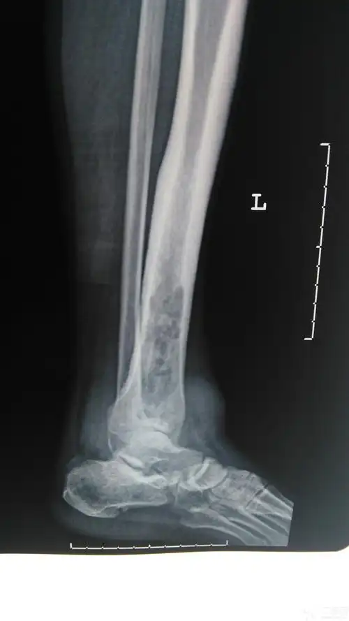 20多年慢性骨髓炎,求助 [病例帖]