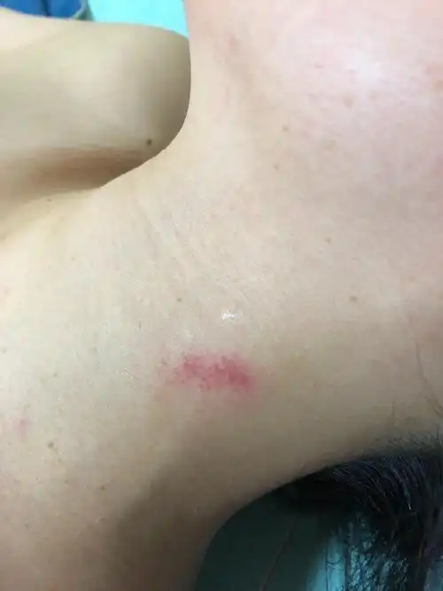 我女友脖子有一个痕迹我不知道是吻痕,还是挠的