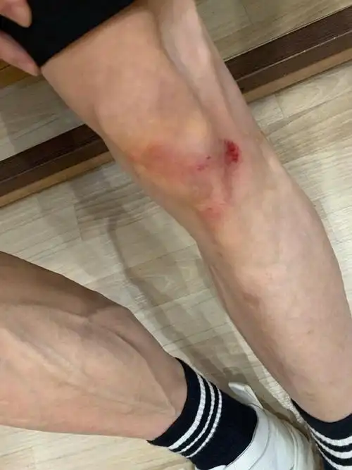 5月15日,张一山在新浪微博发布自身膝盖受伤的照片,发文:"我原本认为