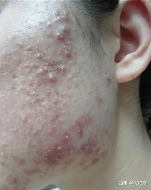 脓包型痤疮痘痘注意事项!