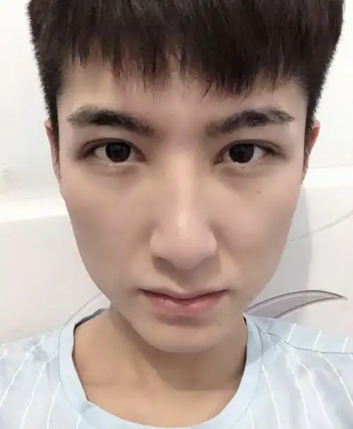 双眼皮全切开眼角案例.可以参考一下.