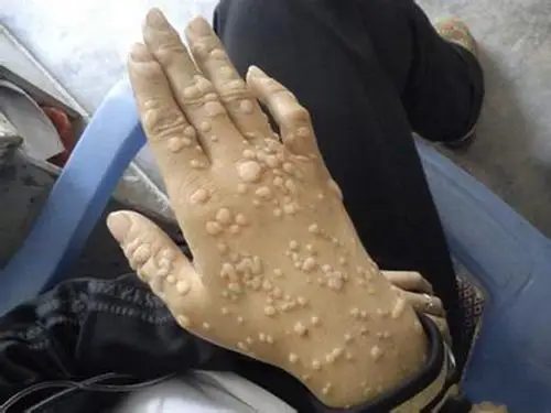 手背严重扁平疣图片