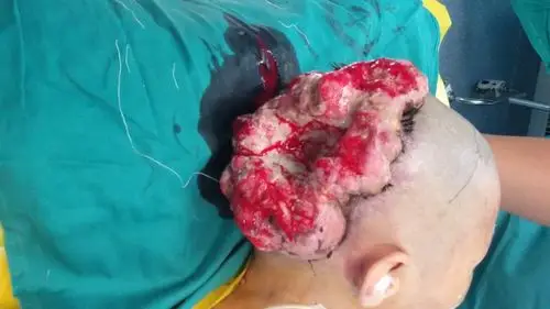 头皮鳞状细胞癌