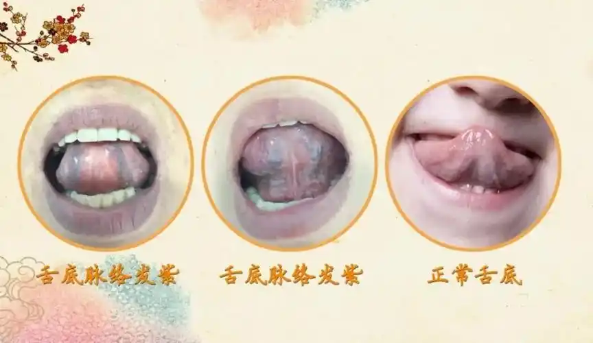 04,看舌头舌底脉络是否色深,瘀曲眼睛,耳朵,鼻子,嗓子,下颌淋巴结出现