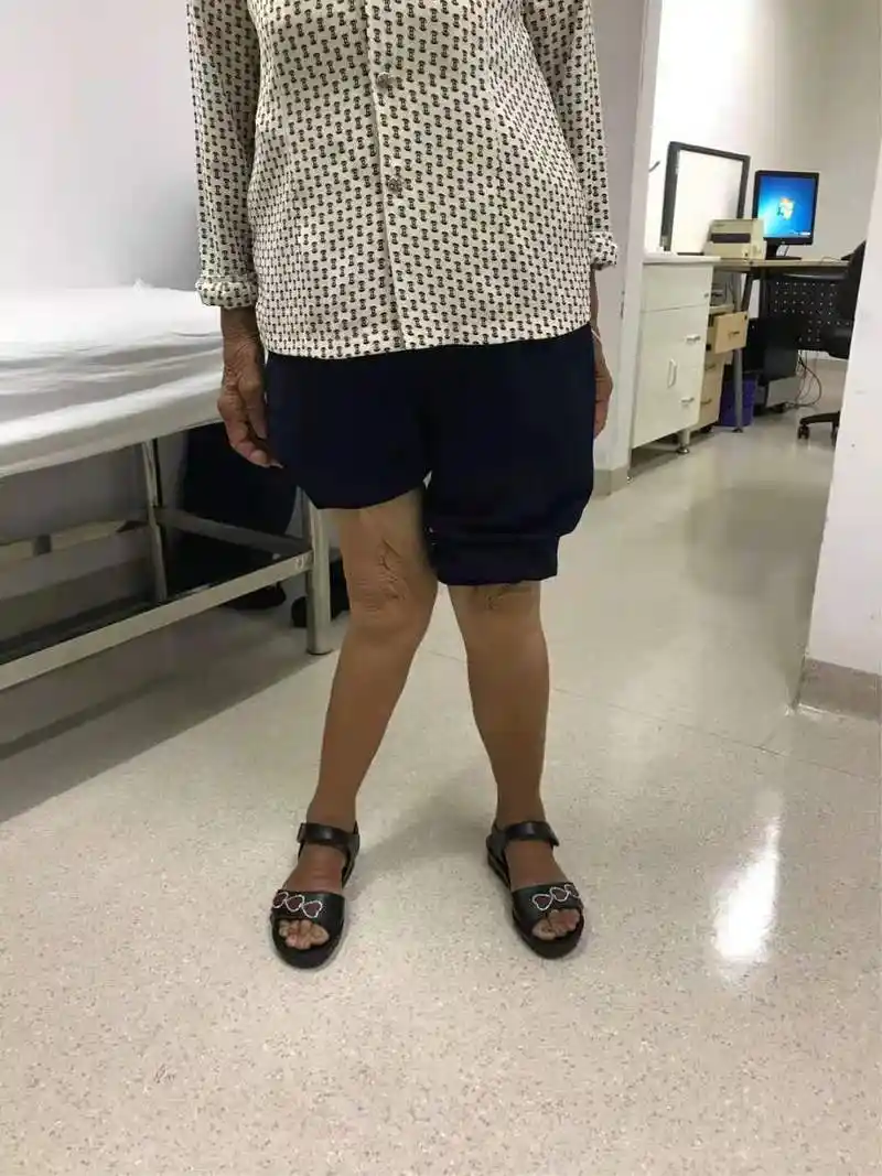 一例严重膝外翻合并骨关节炎患者行膝关节表面置换术