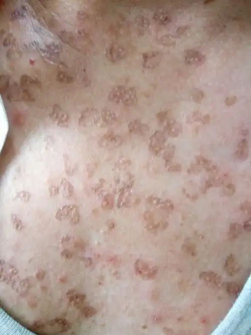 形似烟头烫的疤其实它是汗孔角化