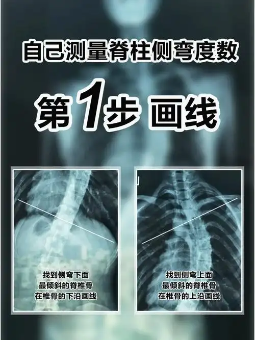自己测量脊柱侧弯度数