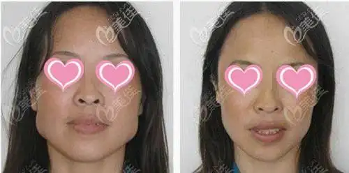 下颌角截骨 下巴截骨手术前后对比