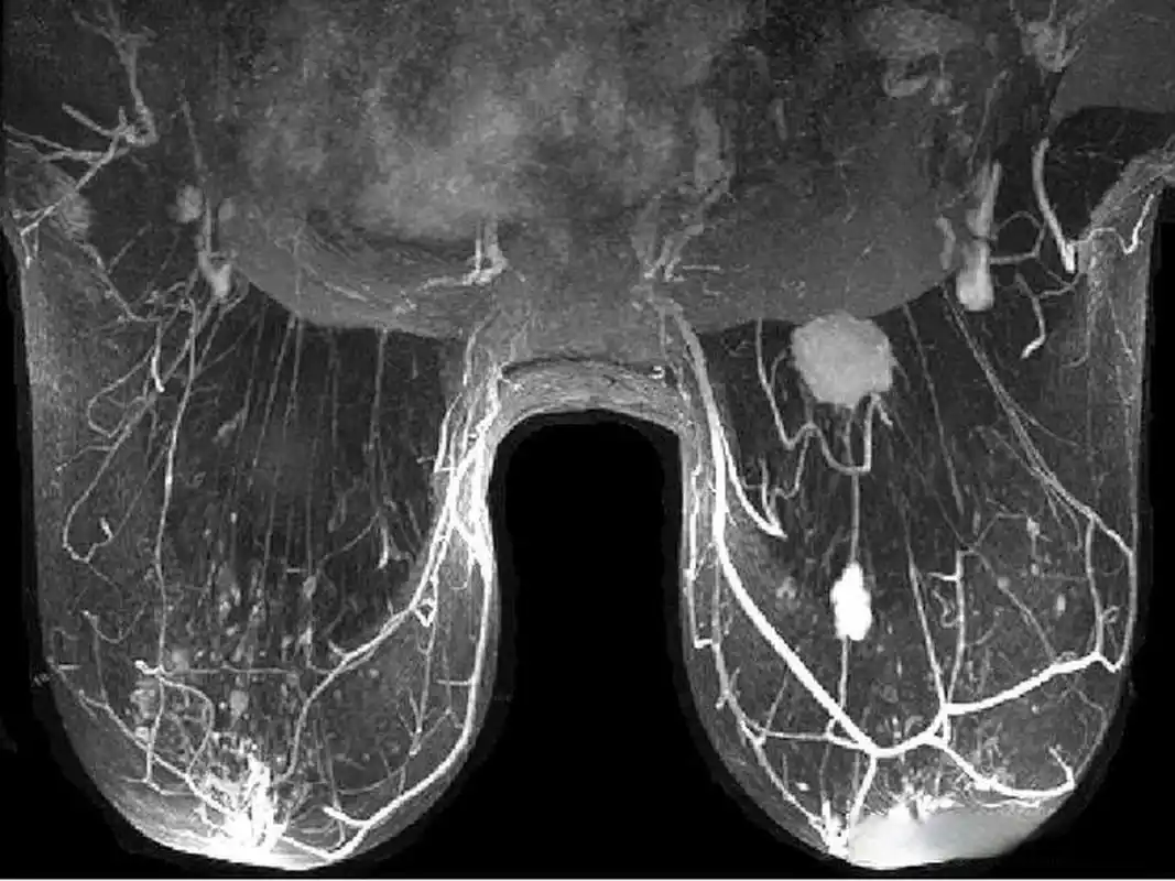 磁共振乳腺成像