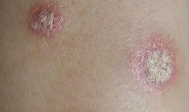 红皮病型银屑病图片