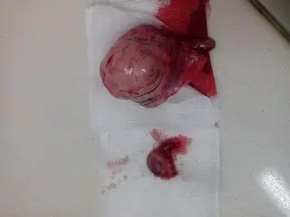 睾丸肿瘤的检查