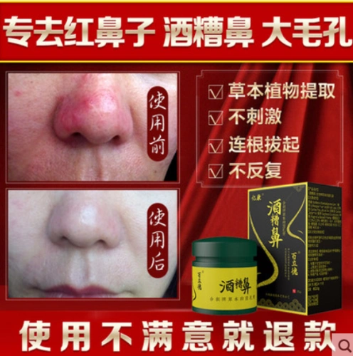 共756 件酒糟鼻螨虫相关商品