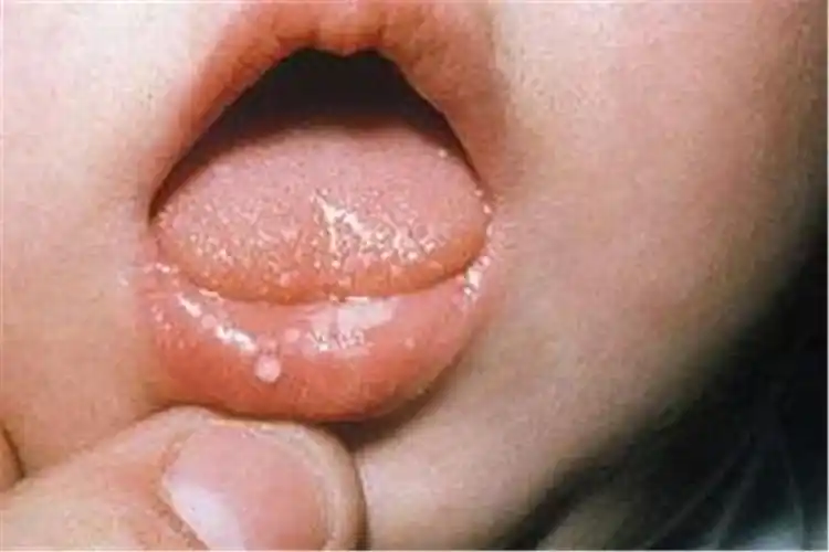 婴儿肛门小白点图(宝宝5种看似异常其实正常的表现) - 乐宝宝贝