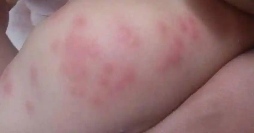 求证!婴儿过敏"确保顺利"-第1张图片-海城博客