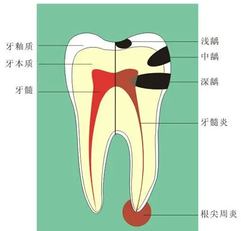 龋齿形成的原因实际上是由于口腔酸碱度过高引起的,而口腔酸碱度过高