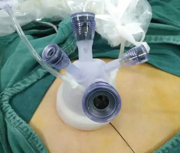 经脐单孔腹腔镜下卵巢畸胎瘤剔除术