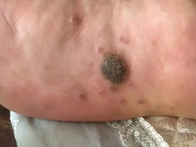 请问中间这个大黑店是猴子,旁边又出来这么多小黑痣是什么,黑痣还硬硬