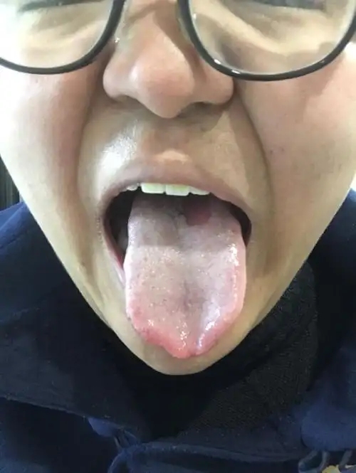 我这舌头上为何有白色的?是艾滋病的征兆吗