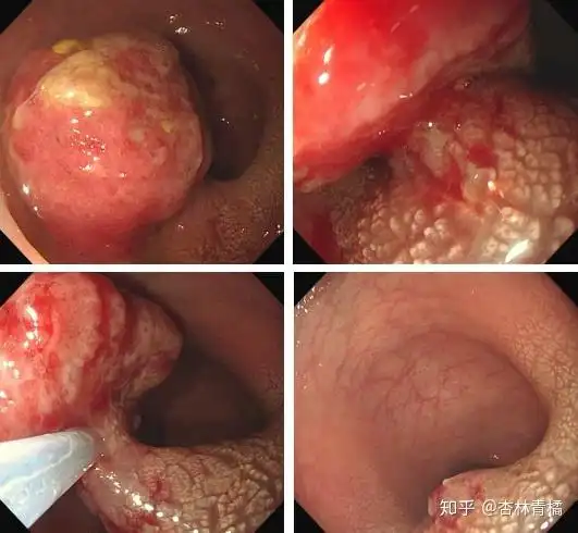 3岁多的小女孩,在幼儿园排便,哭闹不止,老师发现宝宝肛门口脱出一块肉