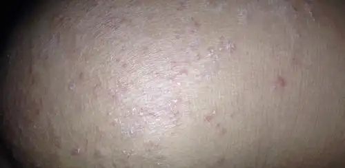 屁股上面长坨越娆越痒是怎么会是