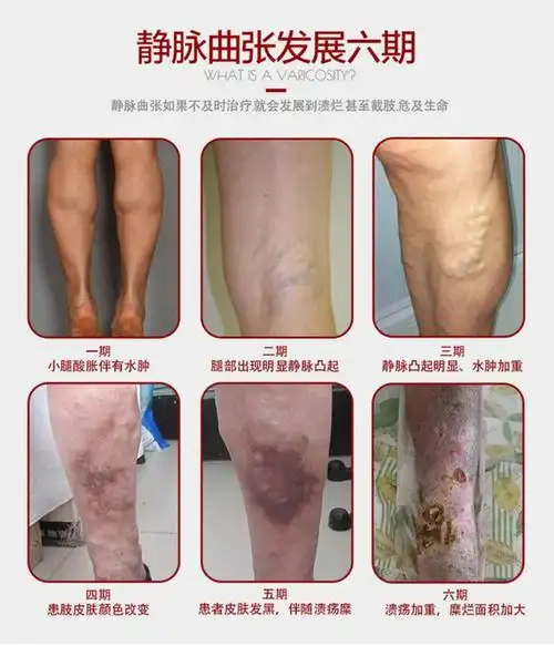 静脉曲张4年了,有什么安全有效的方法吗?