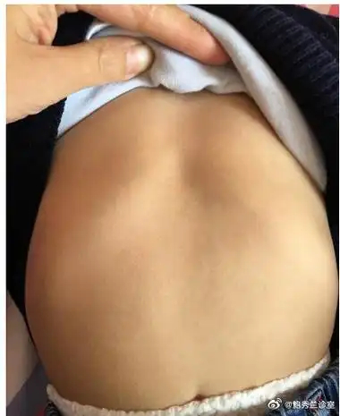 【宝宝肋骨外翻是怎么回事?