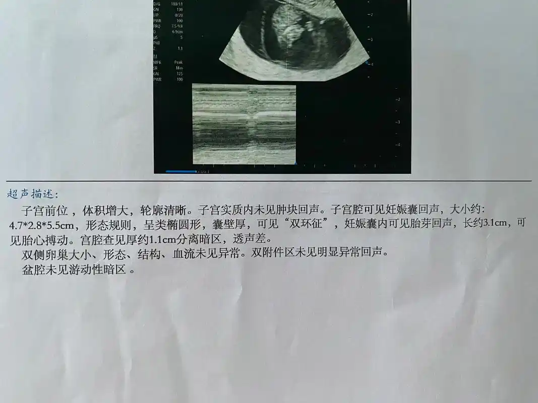 孕4到5周,未见确切胎心胎芽